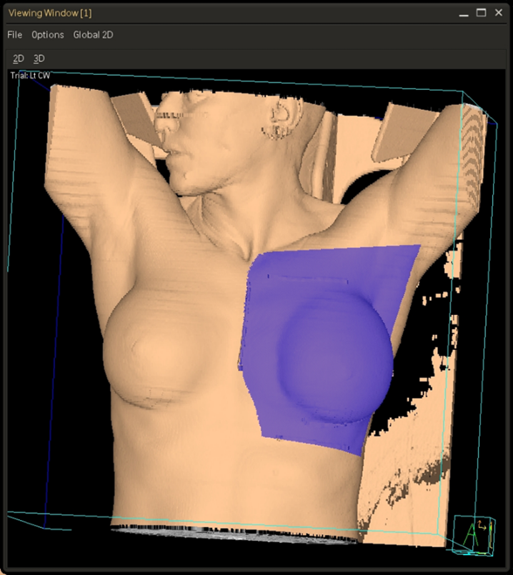Surface rendering of a left breast field