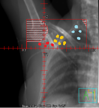 Supraclavicular field at g15 demonstrates the humeral head block, half-beam block (inferior half of field), and inferior isocenter.