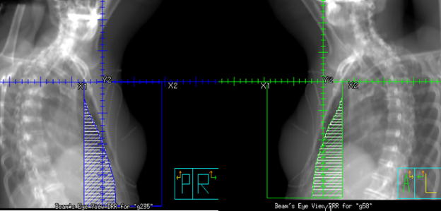 Tangential fields for a 4 field breast treatment using a half beam block.