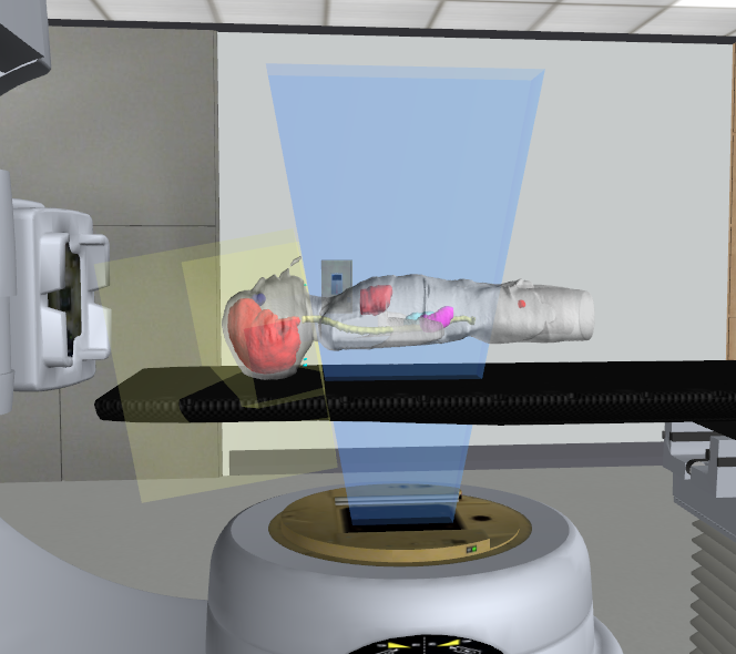 The collimator rotation for the lateral brain fields matches the beam divergence of the PA spine field in the superior direction.