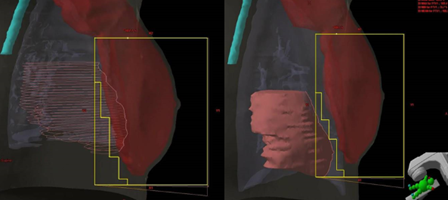 DIBH breast tangent field simulated on Vert demonstrating the reduced heart dose during deep inspiration.