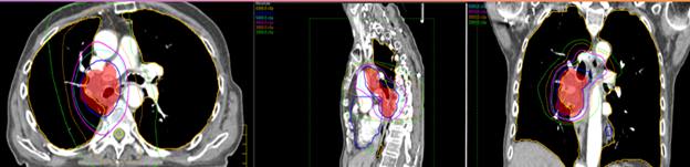 IMRT isodose distribution of the right hilar region.