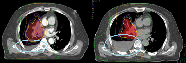 Right lung isodose distribution change with increasing fluid.