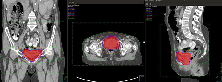 VMAT plan of the bladder.