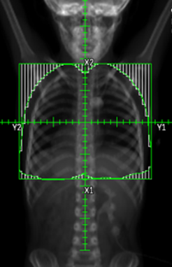 Whole lung DRR for Wilms tumor.