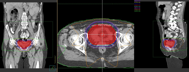 8-field 3D-CRT plan of the bladder.
