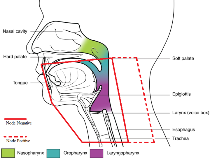 The general field borders for treatments of the oral tongue. Note: a tongue depressor would move the tongue inferior to reduce dose the the hard palate.