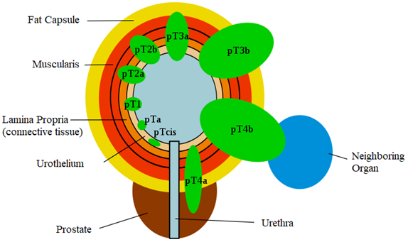 Bladder cancer stages based on depth of invasion of a male.