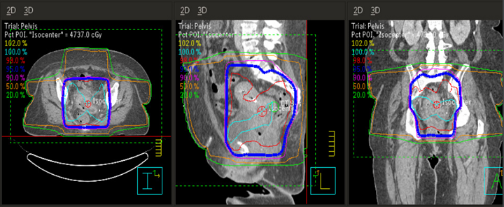 4-field pelvis isodose plan for cervical cancer with equal weighting.
