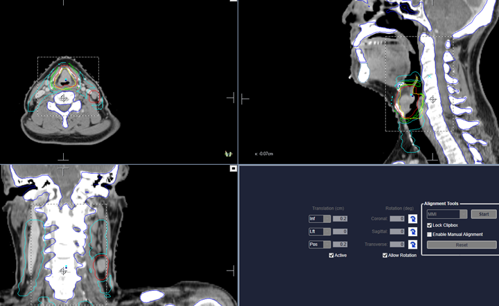 CBCT of a supraglotic malignancy treated with VMAT to 70 Gy in 35 fx.