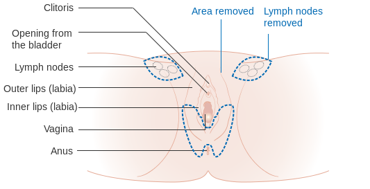 Surgical technique for Vulvular cancers.