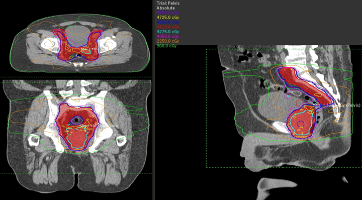 VMAT plan of the prostate and pelvic nodes; Red: PTV 4500 (Dose prescribed such that 96% of PTV4500 receives 45 Gy).