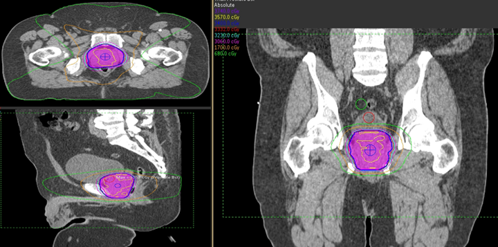 VMAT boost to the prostate. Pink: PTV 7900 (100% of the volume is receiving 79 Gy).