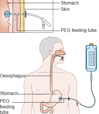 PEG feeding tube placement.