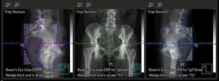 DRRs for a 3-field treatment plan for a cancer of the rectum.