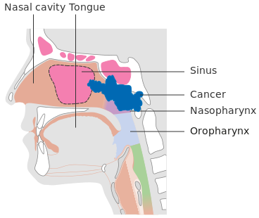 Cancer of the nasopharynx that has invaded the ethmoid sinus (dotted line) and the sphenoid sinus and bone superiorly.