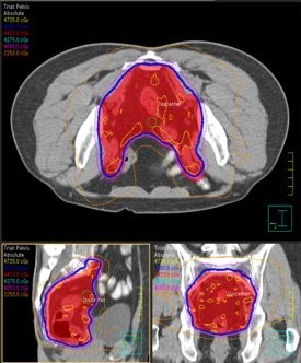 IMRT plan for a cancer of the rectum and pelvic nodes.