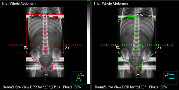 Whole abdomen DRRs for Wilms tumor.