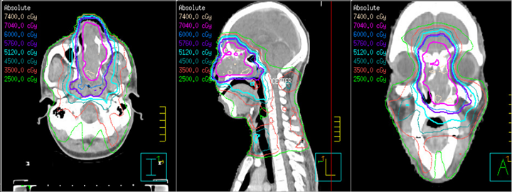 IMRT isodose distribution for a cancer of the nasopharynx.