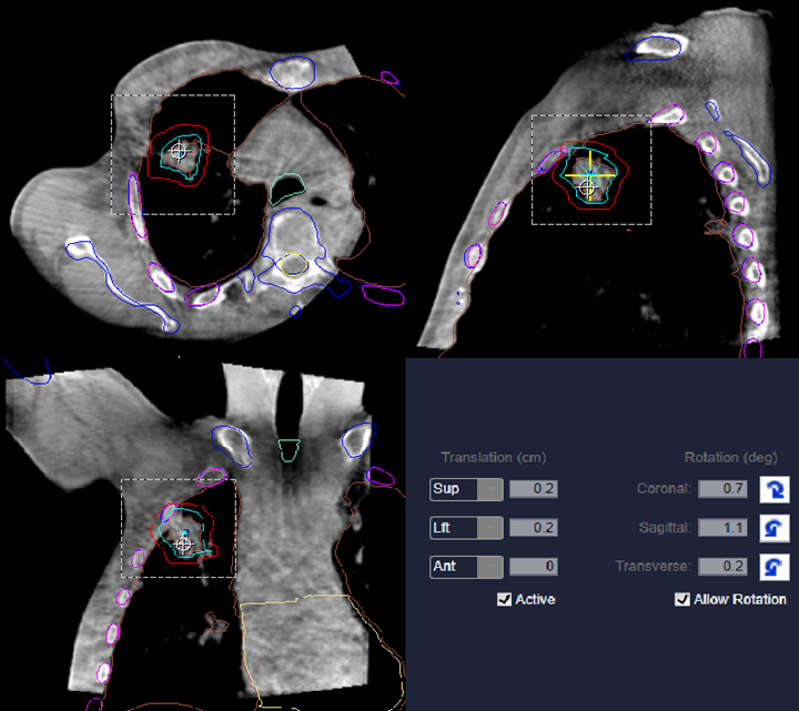 Overview: Breast – Localization & Treatment Procedures in Radiation Therapy