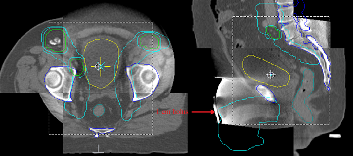 CBCT image of a penile cancer patient.