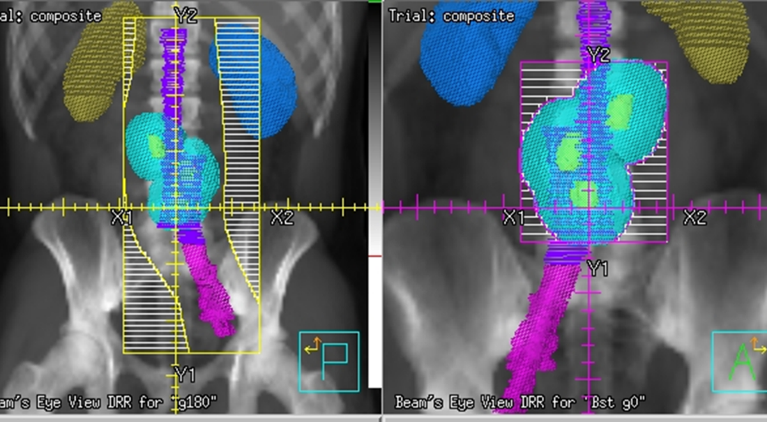 DRR dogleg field for a right-sided seminoma (g180 yellow) and a boost field (pink).