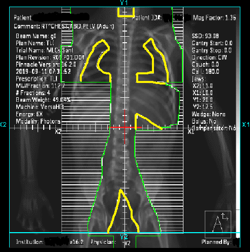 Total nodal irradiation