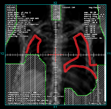 upper total nodal