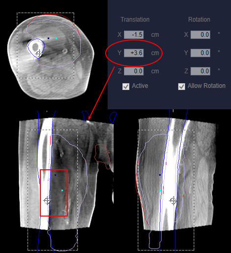 Figure 4. CBCT image showing a 4 cm superior longitudinal offset to visualize the distal pelvis (arrow) and verify correct treatment positioning within the CBCT’s limited field of view. The treatment volume extends outside the inferior FOV. The actual longitudinal (Y) shift was 0.4 mm (4 cm offset – 3.6 cm shift). The genitals were displaced to the patient’s left using a pillowcase sling and are therefore not visualized.
