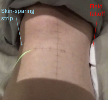 Figure 5. Shows a radiation field near the knee, illustrating light-field falloff on the medial side and a skin-sparing strip on the lateral side.
