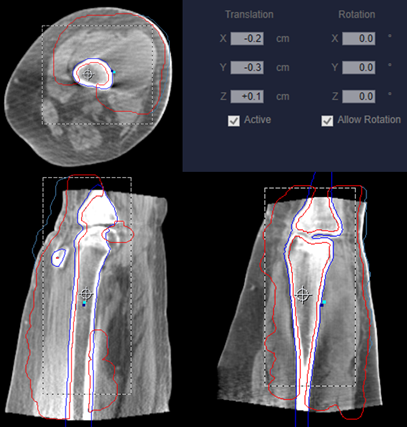 Figure 6. Illustrates the skin-sparing strip concept in an IMRT plan using isodose lines, with treatment fields excluding the posterior leg lymphatics.
