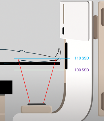 Figure 7. Demonstrates the use of an extended distance to cover the entire treatment area in a single field, avoiding field matching. Note that isocentric treatment is not possible at extended distance, so the patient must be repositioned between fields.
