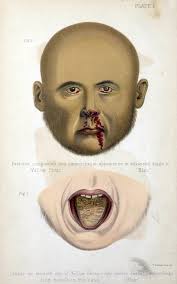 Medical textbook image of man with Yellow Fever.