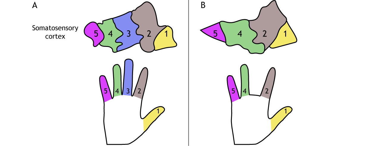 Illustration of somatotopic map before and after amputation. Details in caption.