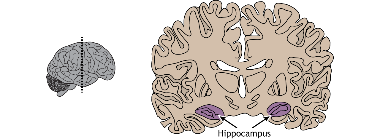 Illustration of a coronal section of the brain showing the location of the hippocampus in the temporal lobe.